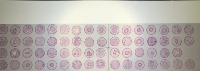 Breast Cancer Tissue Microarray with Matched and Unmatched Adjacent Tissue